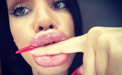 Crazy HUGE Lips Fail: Girls Who Took Lip Injections A Little Too Far