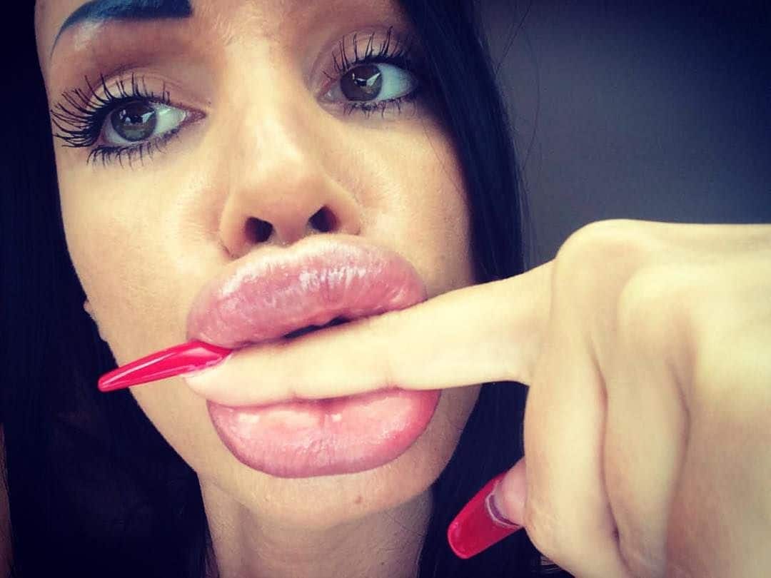 Botox Lips Porn - Crazy HUGE Lips Fail: Girls Who Took Lip Injections A Little ...