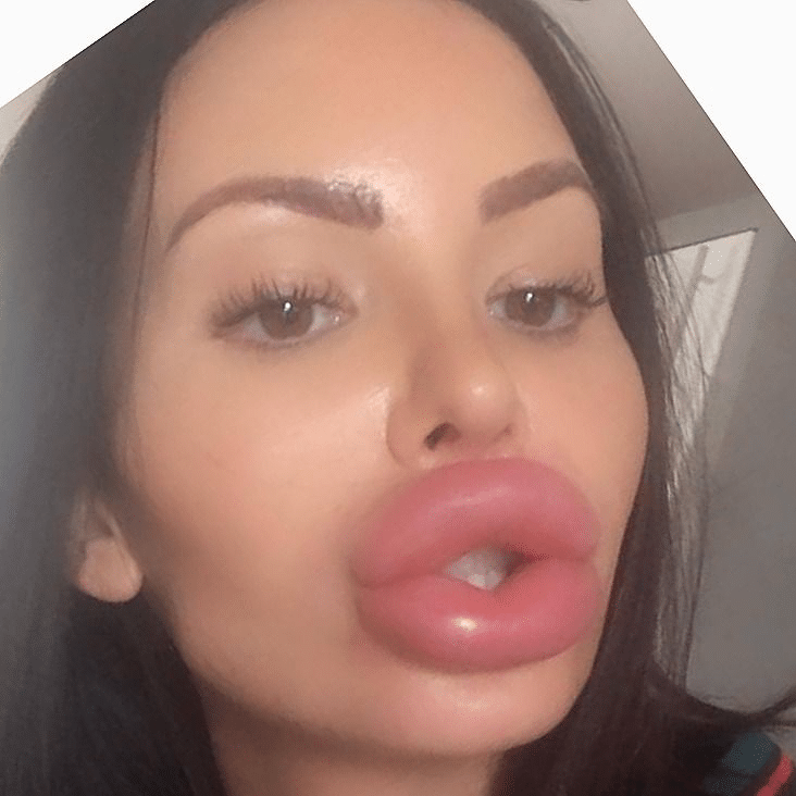 Botox Lips Porn - Crazy HUGE Lips Fail: Girls Who Took Lip Injections A Little ...